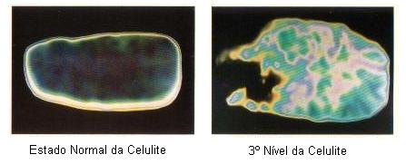 celulite-estado